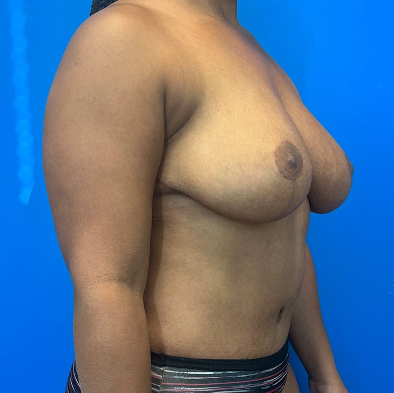 Abdominoplasty Before & After Gallery - Patient 191583 - Image 4