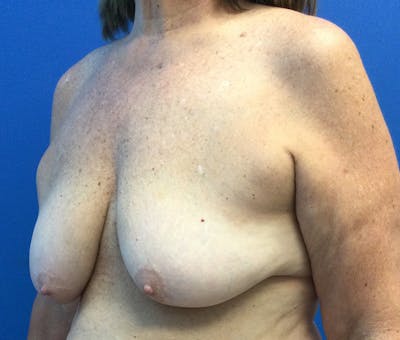 Breast Reduction Before & After Gallery - Patient 965318 - Image 1