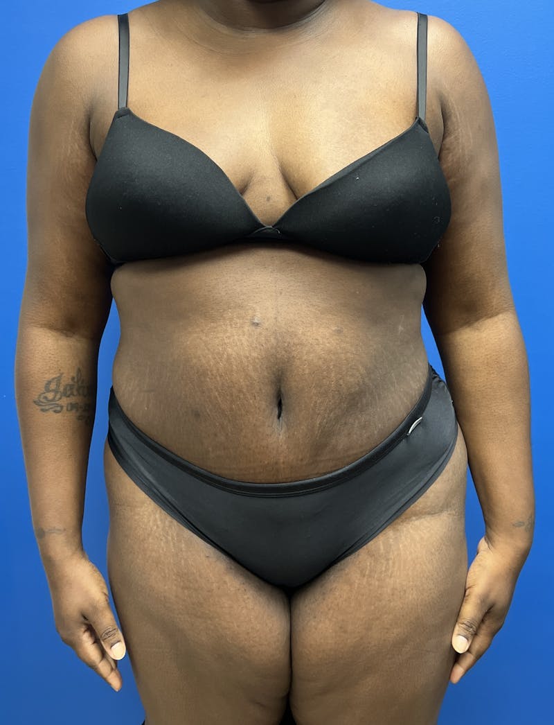 Liposuction Before & After Gallery - Patient 421019 - Image 2
