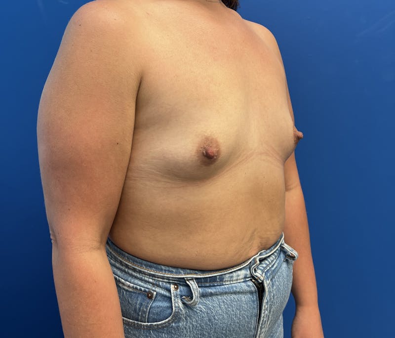 Silicone Breast Augmentation Before & After Gallery - Patient 135626 - Image 3