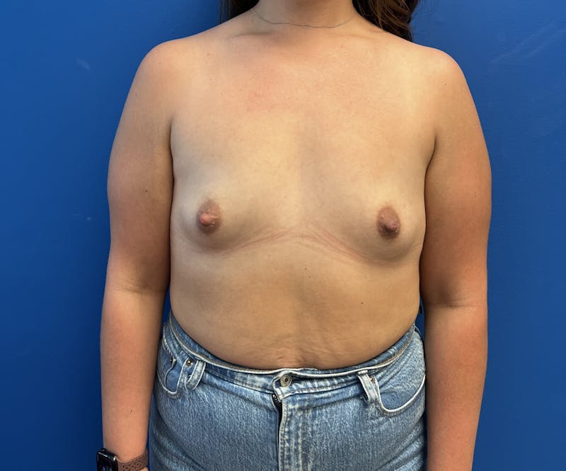 Silicone Breast Augmentation Before & After Gallery - Patient 135626 - Image 1