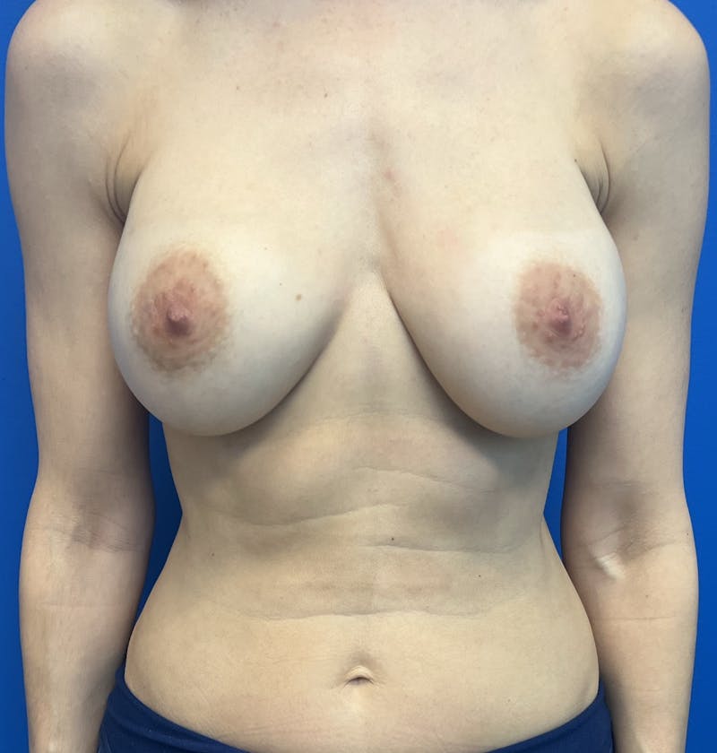 Silicone Breast Augmentation Before & After Gallery - Patient 323025 - Image 1