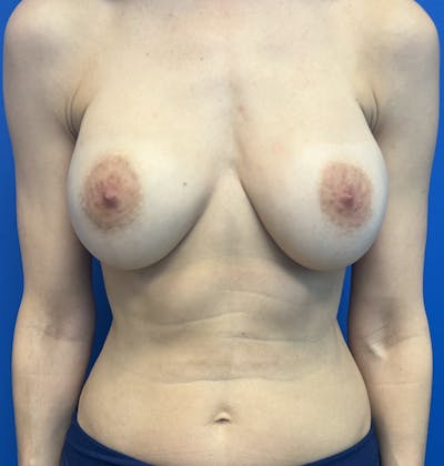 Silicone Breast Augmentation Before & After Gallery - Patient 323025 - Image 1