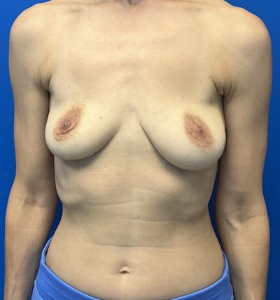 Silicone Breast Augmentation Before & After Gallery - Patient 323025 - Image 2
