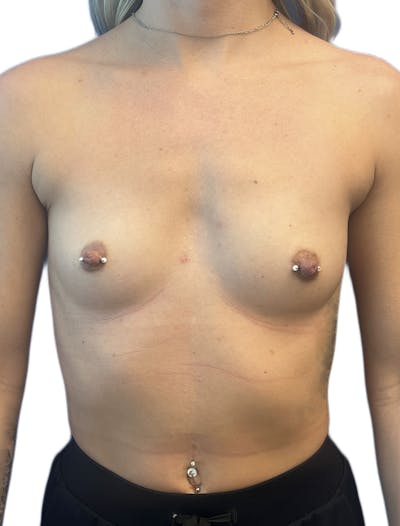 Silicone Breast Augmentation Before & After Gallery - Patient 165025 - Image 1