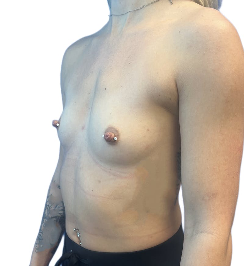 Silicone Breast Augmentation Before & After Gallery - Patient 165025 - Image 5