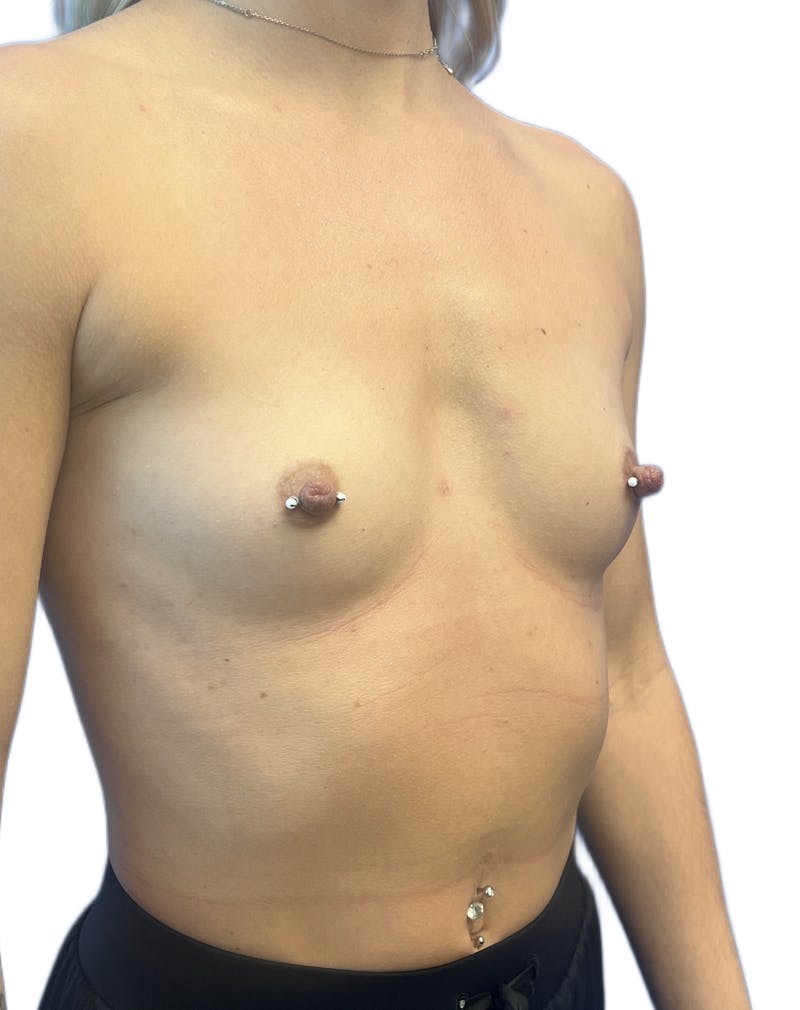 Silicone Breast Augmentation Before & After Gallery - Patient 165025 - Image 3