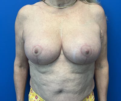 Silicone Breast Augmentation Before & After Gallery - Patient 490848 - Image 2
