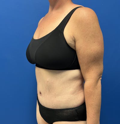 Abdominoplasty Before & After Gallery - Patient 488233 - Image 2