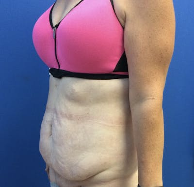 Abdominoplasty Before & After Gallery - Patient 488233 - Image 1