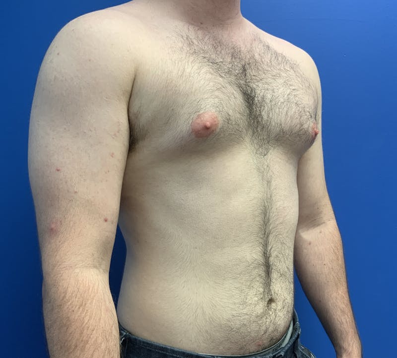 Liposuction Before & After Gallery - Patient 359448 - Image 3