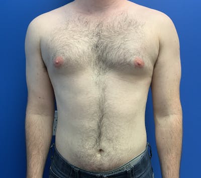 Liposuction Before & After Gallery - Patient 359448 - Image 1
