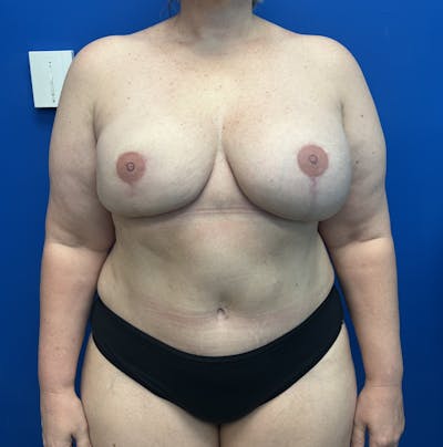 DIEP Flap Reconstruction Before & After Gallery - Patient 382753 - Image 2