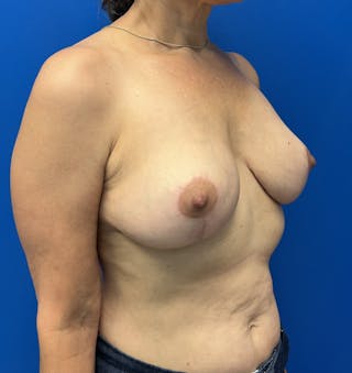 Breast Implant Removal Before & After Gallery - Patient 550077 - Image 4