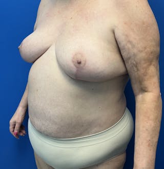 Breast Lift Before & After Gallery - Patient 111629 - Image 4