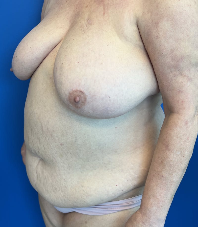 Breast Lift Before & After Gallery - Patient 111629 - Image 3