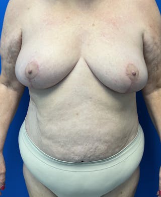 Breast Lift Before & After Gallery - Patient 111629 - Image 2