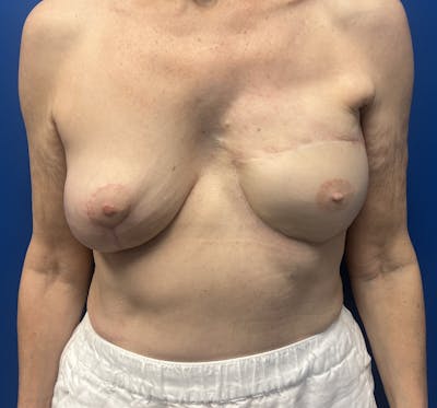 DIEP Flap Reconstruction Before & After Gallery - Patient 331003 - Image 2