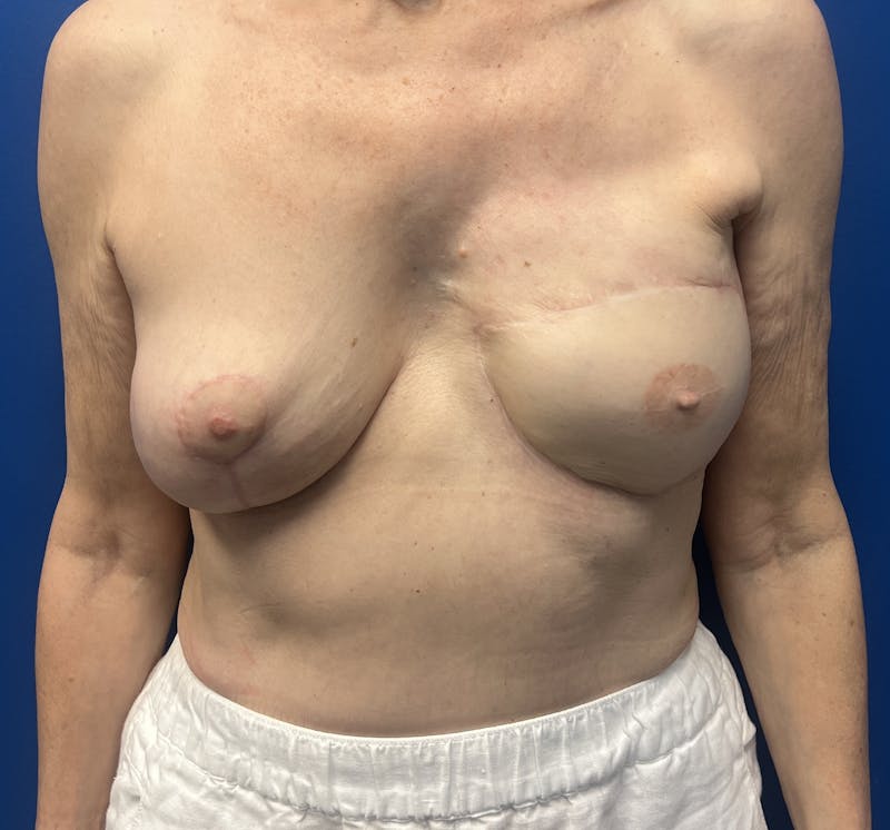 DIEP Flap Reconstruction Before & After Gallery - Patient 331003 - Image 2