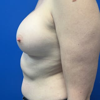 Silicone Breast Augmentation Before & After Gallery - Patient 212465 - Image 6