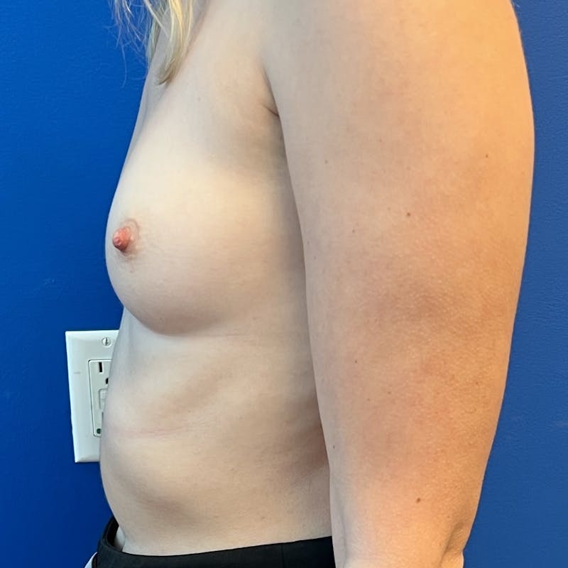 Silicone Breast Augmentation Before & After Gallery - Patient 212465 - Image 5