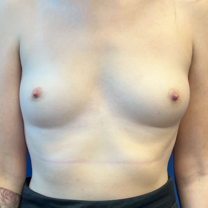 Silicone Breast Augmentation Before & After Gallery - Patient 212465 - Image 1