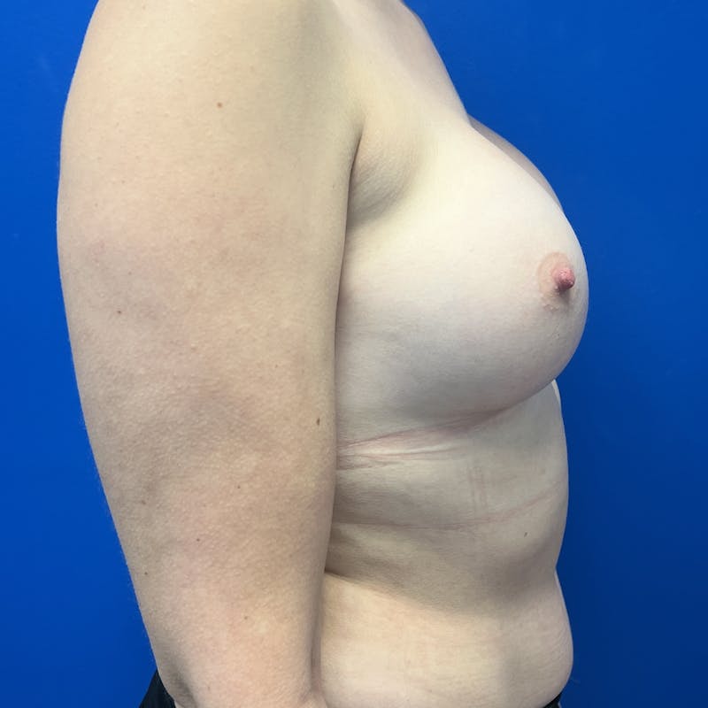 Silicone Breast Augmentation Before & After Gallery - Patient 212465 - Image 10