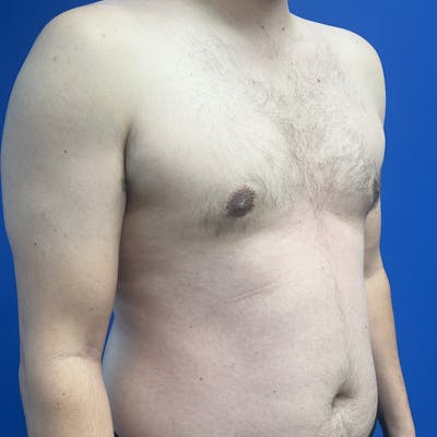 Male Breast Reduction Before & After Gallery - Patient 393474 - Image 2