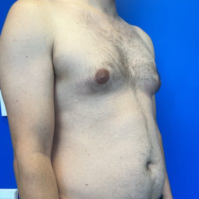 Male Breast Reduction Before & After Gallery - Patient 393474 - Image 1