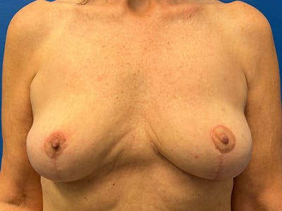Breast Implant Removal Before & After Gallery - Patient 296161 - Image 2
