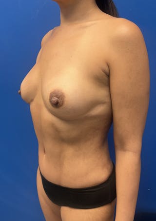 Breast Reconstruction Revision Before & After Gallery - Patient 391583 - Image 6