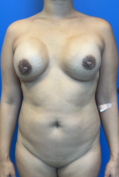 Breast Reconstruction Revision Before & After Gallery - Patient 391583 - Image 1