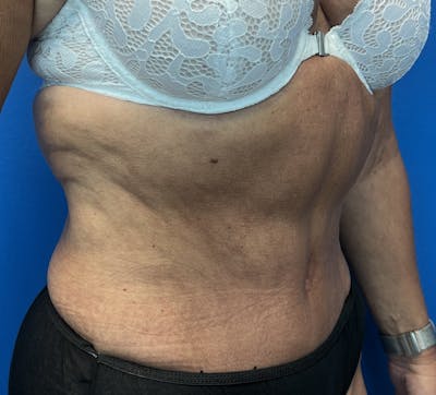 Abdominoplasty Before & After Gallery - Patient 247994 - Image 2