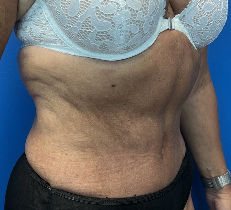 Abdominoplasty Before & After Gallery - Patient 247994 - Image 2
