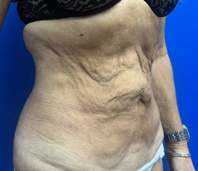 Abdominoplasty Before & After Gallery - Patient 247994 - Image 1