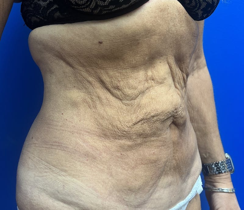 Abdominoplasty Before & After Gallery - Patient 247994 - Image 1