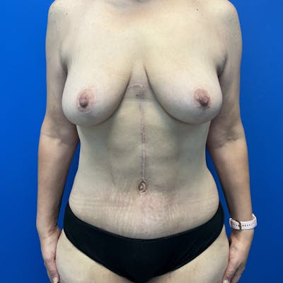 Abdominoplasty Before & After Gallery - Patient 130767 - Image 2