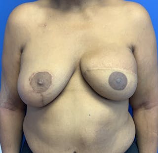 Breast Reconstruction Revision Before & After Gallery - Patient 204598 - Image 2