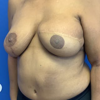 Breast Reconstruction Revision Before & After Gallery - Patient 204598 - Image 4