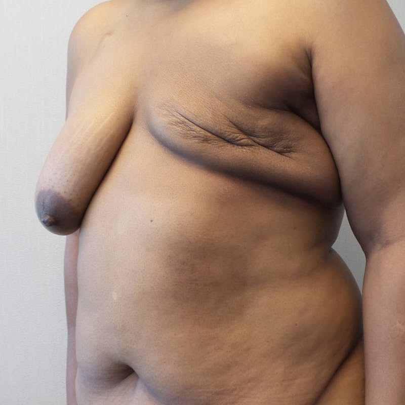 Breast Reconstruction Revision Before & After Gallery - Patient 204598 - Image 3