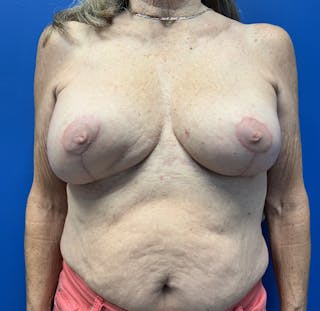 Breast Reconstruction Revision Before & After Gallery - Patient 313382 - Image 2