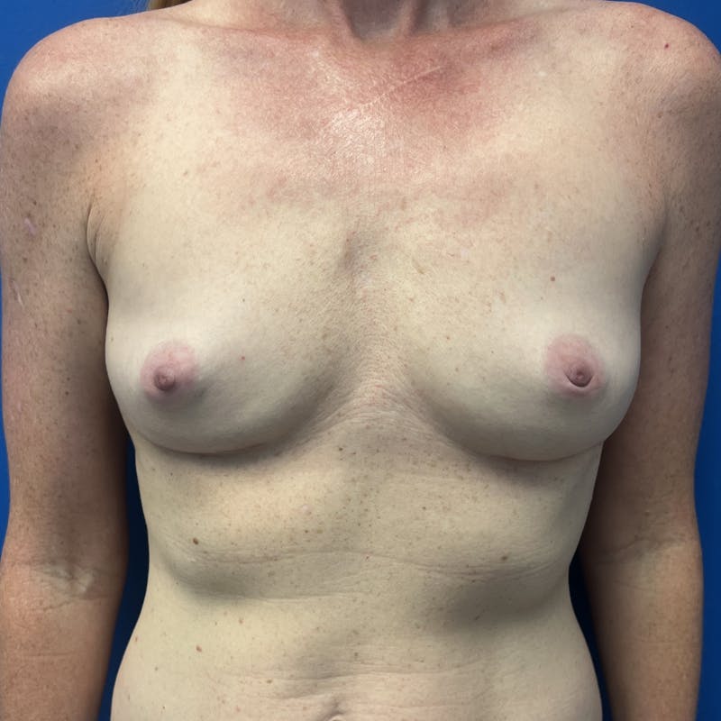 Breast Implant Removal Before & After Gallery - Patient 337498 - Image 1