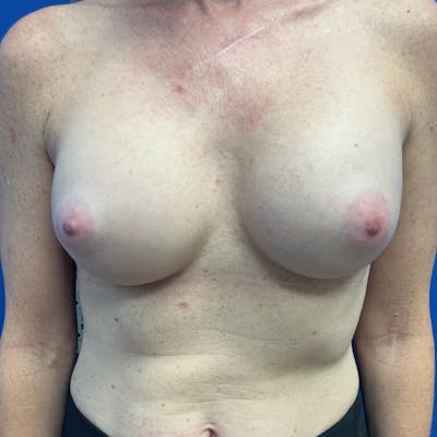 Breast Implant Removal Before & After Gallery - Patient 337498 - Image 2