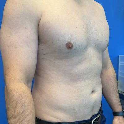 Liposuction Before & After Gallery - Patient 168380 - Image 1