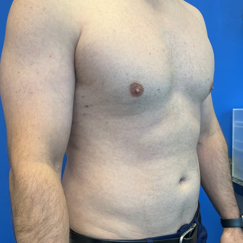 Liposuction Before & After Gallery - Patient 168380 - Image 1