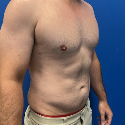 Liposuction Before & After Gallery - Patient 168380 - Image 2