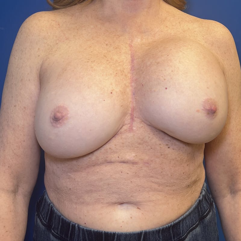 Breast Implant Removal Before & After Gallery - Patient 262523 - Image 1