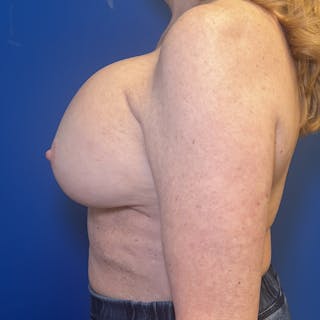 Breast Implant Removal Before & After Gallery - Patient 262523 - Image 2
