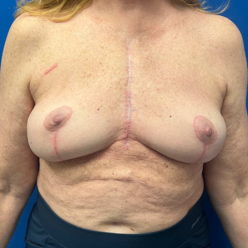 Breast Implant Removal Before & After Gallery - Patient 262523 - Image 3