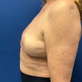 Breast Implant Removal Before & After Gallery - Patient 262523 - Image 4